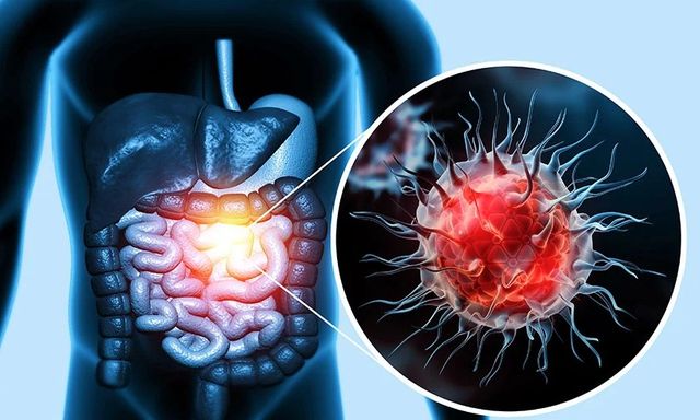 Ung thư đại trực tràng gia tăng đáng báo động: 4 dấu hiệu ở xa “tít tắp” có thể cảnh báo sớm