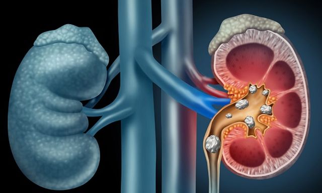 Nhiều người Việt phải cắt bỏ thận chỉ vì tự ý dùng 1 thứ tưởng là 