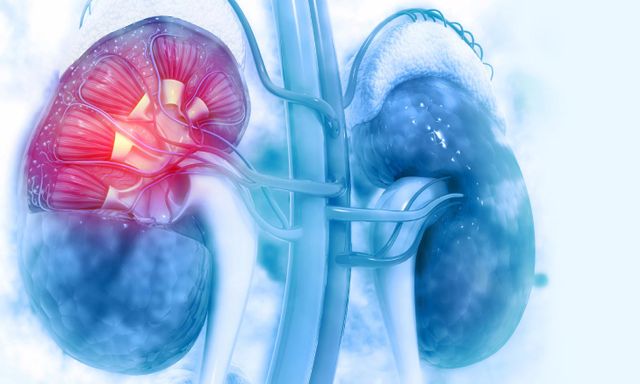 2 quả thận bị 