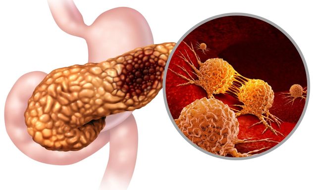 3 người trong 1 nhà đều mắc ung thư tuyến tụy: Bất ngờ với 