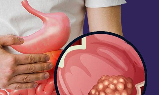 Phát hiện ung thư giai đoạn 4 ở tuổi 26, nam thanh niên hối hận: Giá như tôi không bỏ qua triệu chứng này