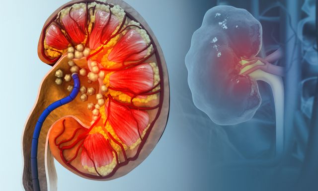 Thận chi chít sỏi chỉ vì uống 1 thứ để 