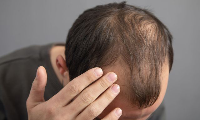 Thường xuyên ăn 5 món này, đừng trách vì sao tóc rụng lả tả