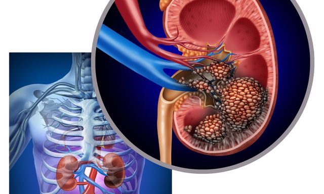 Người đàn ông bất ngờ phát hiện ung thư thận khi đi khám sức khỏe định kỳ: Tôi mới 32 tuổi, sao có thể...