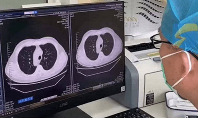 Cảm lạnh và ho, phổi trái của nam sinh đột nhiên 