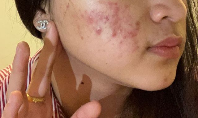 CẢNH BÁO: 4 kiểu mụn rất dễ là 