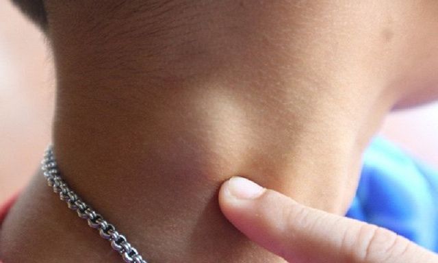 Đi khám được chẩn đoán u lành, sang nơi khác phát hiện có nhiều nhân ung thư tuyến giáp