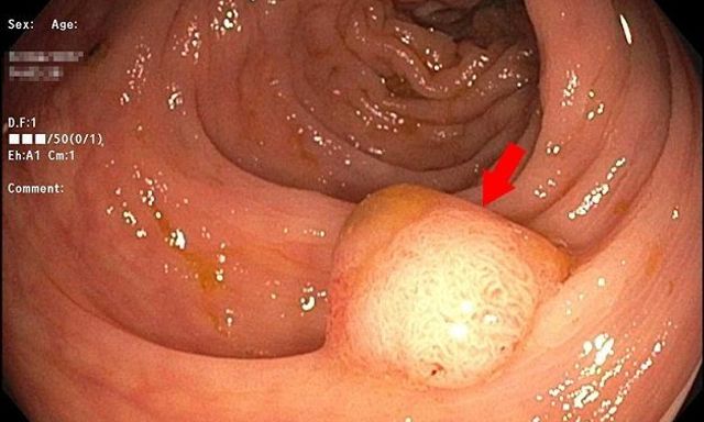 20 tuổi đã suýt bị ung thư đại tràng: Bác sĩ nói người trẻ có 4 dấu hiệu này khi đi vệ sinh phải đi khám gấp