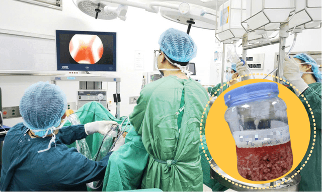 Kỳ tích y học Việt Nam: Cụ ông 94 tuổi được bóc u tiền liệt tuyến to gấp 5 lần bình thường