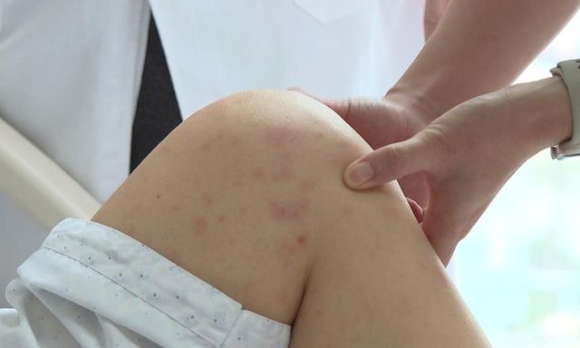 Hà Nội: Cô giáo mầm non viêm phổi do mắc thủy đậu, sai lầm vì 