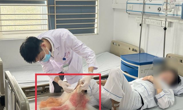 Suýt mất chân vì đắp lá chữa bỏng lửa suốt 1 tháng