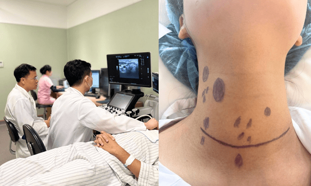 Cô gái 24 tuổi ở Hà Nội phát hiện ung thư tuyến giáp di căn hơn 20 hạch sau khi sờ thấy 1 thứ ở cổ