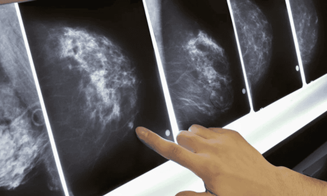 Người phụ nữ không đau, không u vẫn mắc ung thư vú: BS ung bướu cảnh báo 3 việc chị em phải làm đều đặn để bảo vệ mình