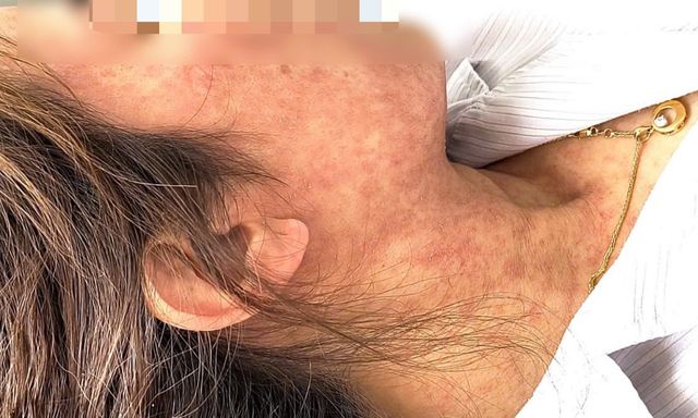 Người phụ nữ 42 tuổi bị nhiễm trùng, xuất huyết do biến chứng bệnh sởi, BS Bệnh viện Bệnh Nhiệt đới Trung ương nhắc làm ngay 1 việc để phòng tránh 