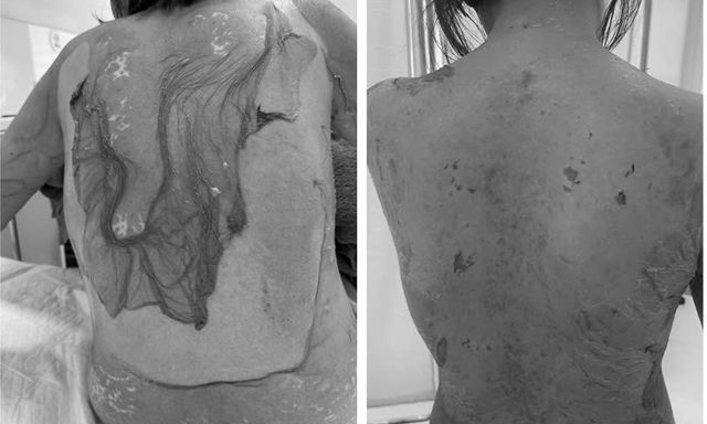 Hải Phòng: 1 phụ nữ 35 tuổi bị tróc da như 