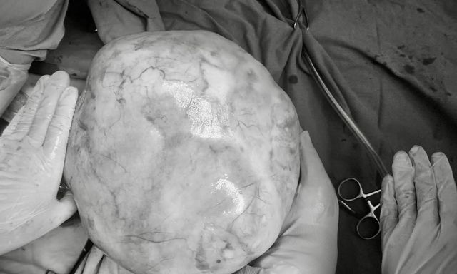 Hy hữu: Bé gái 14 tuổi mang khối u buồng trứng hơn 4kg, bác sĩ cảnh báo những dấu hiệu sớm nhưng hay bị bỏ qua