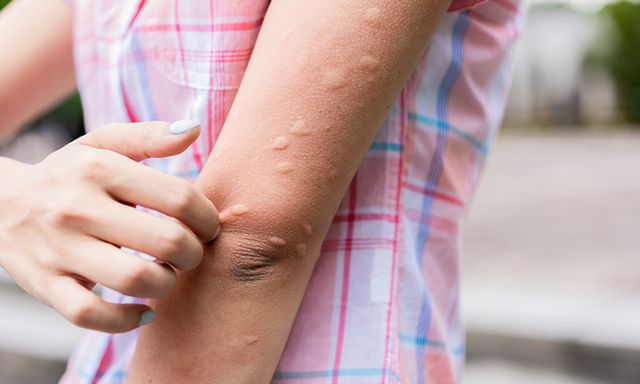 Các phản ứng dị ứng và miễn dịch sau tiêm vắc-xin: Bác sĩ Bệnh viện Bạch Mai khuyên 