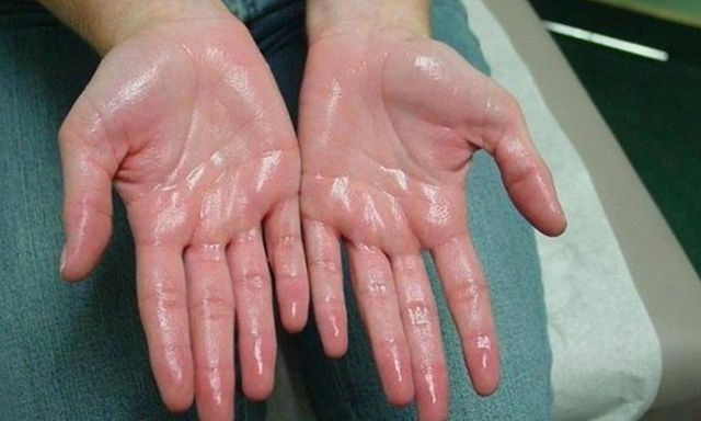 Khuyên thật: Thấy 5 thứ trên bàn tay phải đi khám thận ngay! 