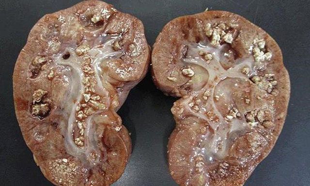 Người phụ nữ 58 tuổi thận bám đầy mủ, suýt mất thận: BS cảnh báo tuyệt đối không trì hoãn đi bệnh viện khi cơ thể phát tín hiệu
