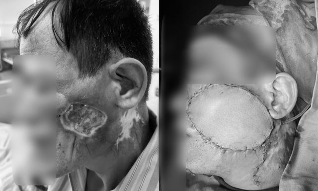 Bác sĩ Bệnh viện Bệnh Nhiệt đới Trung ương cảnh báo: Nốt nhỏ trên da có thể là ung thư, người đàn ông này đã phải cắt bỏ xương, chấp nhận biến dạng mặt