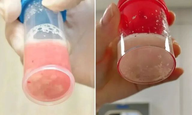 Cô bé 12 tuổi phổi trắng xóa và đông đặc sau 1 ngày bị sốt, bác sĩ cảnh báo: Đừng lúc nào cũng tưởng con cảm lạnh!
