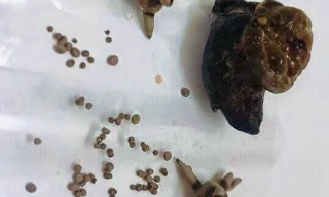 Bệnh sỏi thận: Vì sao trong cùng 1 quả thận lại có các viên sỏi khác nhau và chia sẻ của bác sĩ 