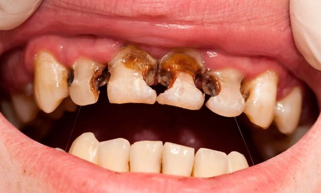 Trẻ thiếu canxi thường phát ra 5 tín hiệu: Bệnh viện Nhi đồng 2 cảnh báo đừng chủ quan