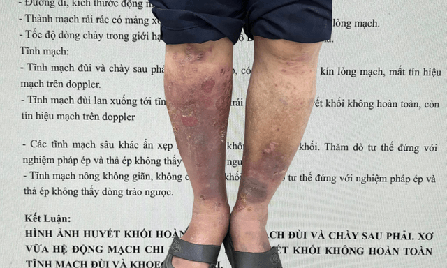 Bác sĩ chuyên ngành mạch máu xót xa khi bệnh nhân biến chứng suy giãn tĩnh mạch chi dưới, nguy cơ huyết khối, tử vong vẫn: 