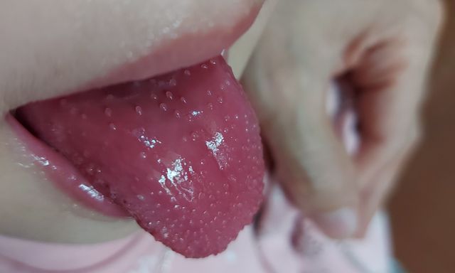 Trẻ sốt ngày không hạ, mắt đỏ, môi đỏ, lưỡi đỏ: Cẩn trọng bệnh Kawasaki có thể gây tổn thương tim