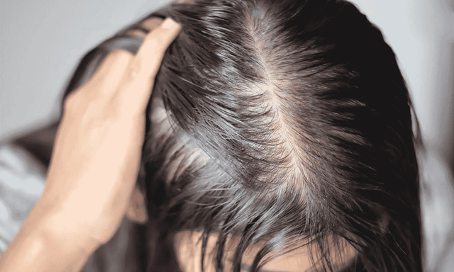 Tưởng stress vì thi cử nên rụng tóc, cô gái 22 tuổi phát hiện căn bệnh đang âm thầm đang phá hủy thận