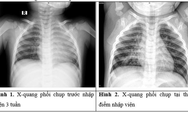 Phát hiện dị vật 