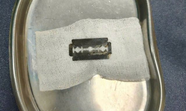 Dao lam nằm trong dạ dày người đàn ông Hà Nội: Bác sĩ gắp thành công, người bệnh thoát nguy cơ thủng dạ dày