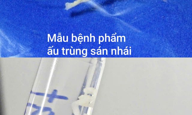 Phát hiện sán dài 7cm trong cơ thể người đàn ông 40 tuổi ở Hà Nội, không ăn đồ tái sống