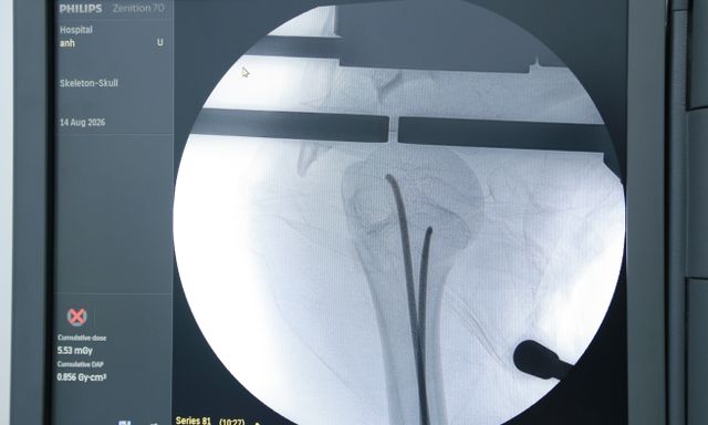 Bé gái 14 tuổi gãy xương cánh tay sau tai nạn xe đạp điện được phẫu thuật qua hai vết mổ nhỏ