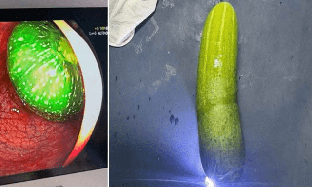 Nam sinh lớp 9 nhập viện vì trót đưa quả dưa chuột 20cm vào hậu môn