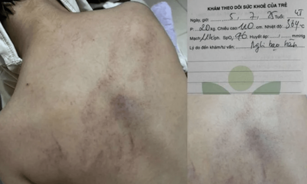 NÓNG - Vụ bé gái 4 tuổi bị cô giáo ném vào tường, đánh tím lưng: Bộ Y tế vào cuộc!