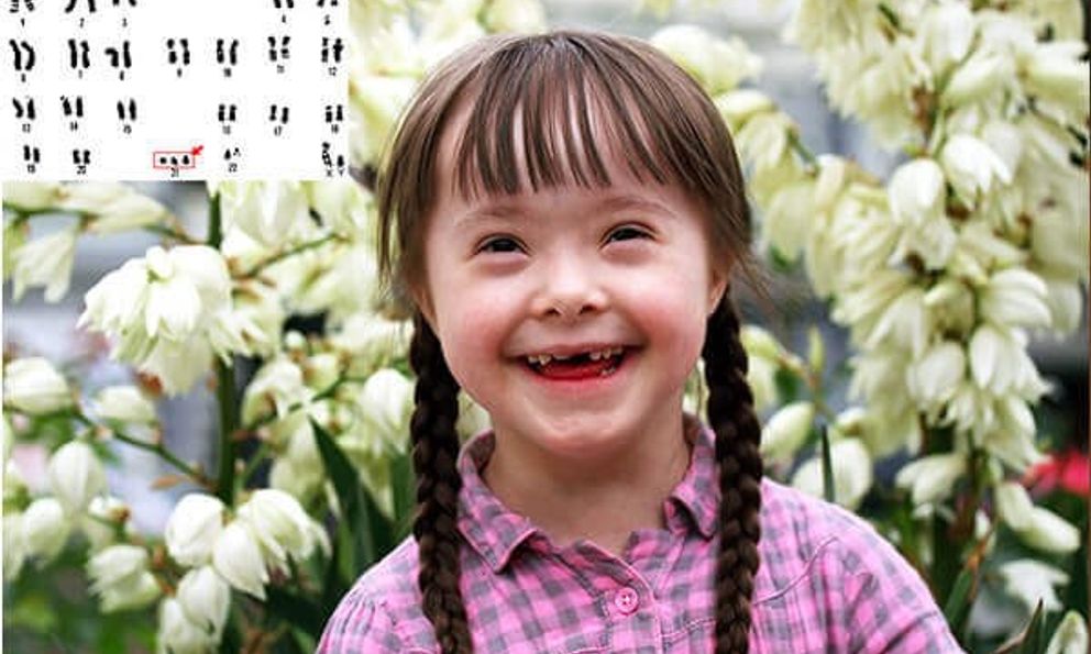 Kỳ tích y khoa Nhật Bản: Chỉnh sửa gen, loại bỏ thành công nhiễm sắc thể gây hội chứng Down 