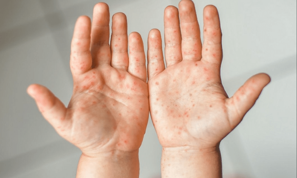 Nóng: Xuất hiện biến chủng virus EV71 tay chân miệng có khả năng gây viêm não, suy hô hấp cực nhanh