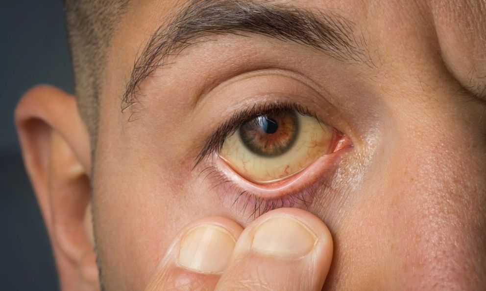 8 dấu hiệu bệnh gan biểu hiện ngay trên mặt: Tuyệt đối đừng coi thường!