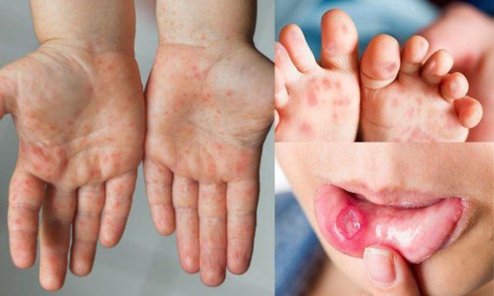 Bệnh viện Nhi TW cảnh báo một bệnh dịch đã 