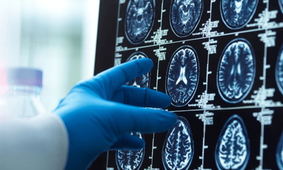 AI lần đầu hỗ trợ mổ não trực tiếp trên người: Cuộc thử nghiệm có thể thay đổi cách bác sĩ phẫu thuật
