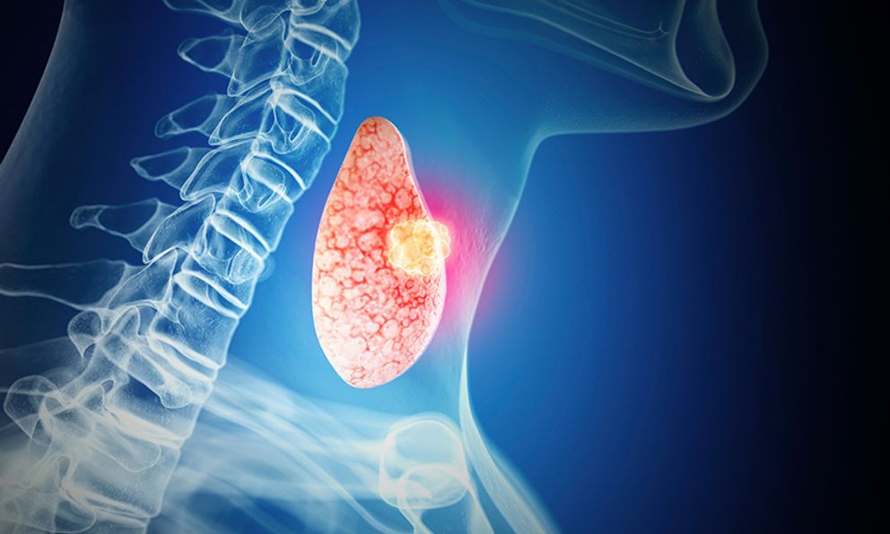 Bác sĩ CK II, khoa ung bướu nói thẳng: Nhiều người đang khoẻ, sau khi đi khám sức khoẻ định kỳ liền phát hiện ra ung thư - TẠI SAO? 