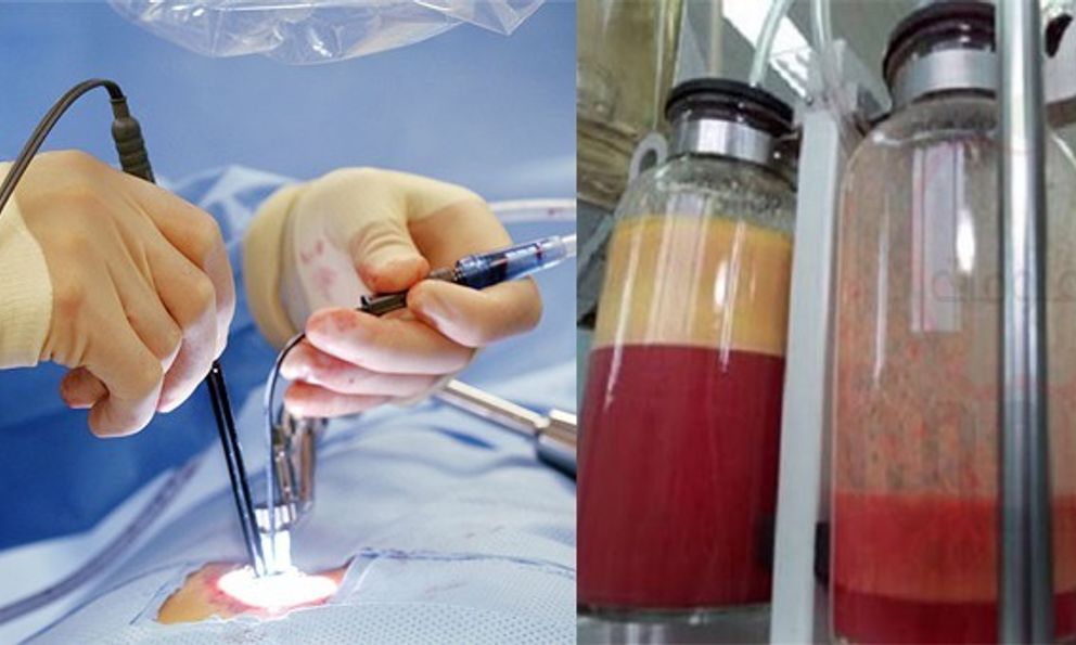 Bê bối của thị trường thẩm mỹ trị giá 22 tỉ USD: nạn nhân nức nở kể trải nghiệm HÚT MỠ đau đớn 