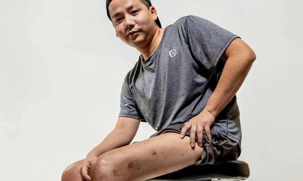 Khoa Pug Chi 3 tỷ để cao thêm 7 cm: Bác sĩ nói gì?