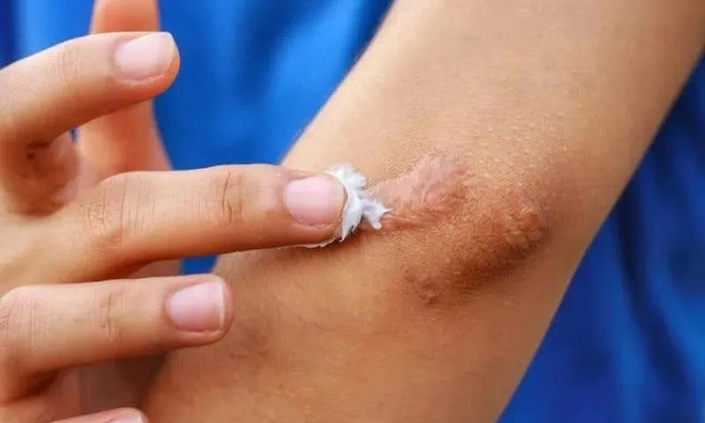 Thu hồi trên phạm vi toàn quốc lô gel trị sẹo chứa chất bảo quản vượt ngưỡng cho phép: Có thể gây dị ứng, rối loạn nội tiết