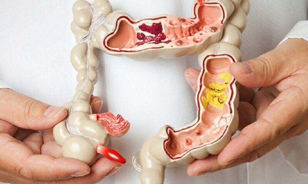 Căn bệnh ung thư từng đoạt mạng 930.000 người/năm: 3 điều bác sĩ khuyên nên NGỪNG ngay trước khi quá muộn