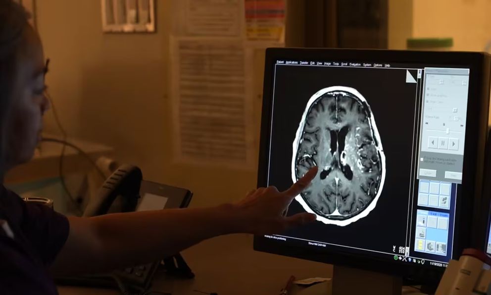 Bước ngoặt điều trị UNG THƯ não: Kỹ thuật mới từ Canada giúp bệnh nhân kéo dài thời gian sống