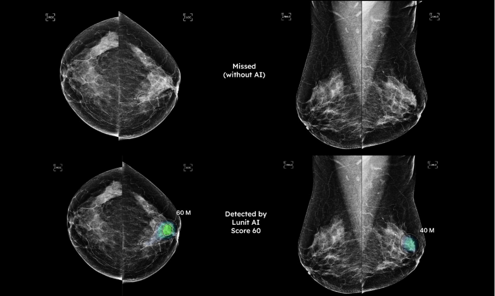 Hi vọng mới: Phát hiện sớm 4 loại ung thư bằng công nghệ AI 