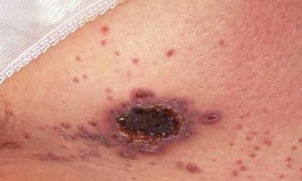 Đi khám da liễu, người đàn ông bàng hoàng nhận kết quả HIV: Những ca phát hiện khiến bác sĩ “giật mình”