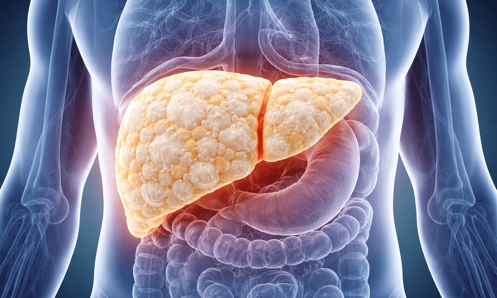 Người phụ nữ có 2 lá gan phủ trắng lớp mỡ kèm 2 khối u, bác sĩ cũng phát sợ vì thói quen uống